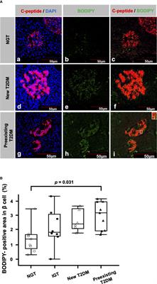 Lipid droplet accumulation in β cells in patients with type 2 diabetes is associated with insulin resistance, hyperglycemia and β cell dysfunction involving decreased insulin granules